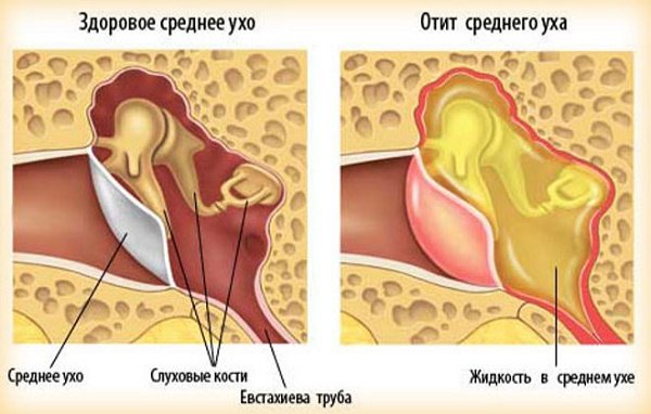 Чем лечат уши детям в домашних условиях Чем лечат уши детям в домашних условиях