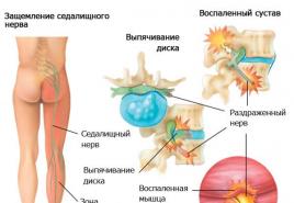 Léčba vertebrální kýly pomocí cvičební terapie