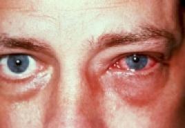Alergická konjunktivitida u dítěte: příznaky a léčba Jak léčit alergickou konjunktivitidu u dětí