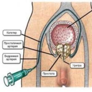 Vasküler embolizasyon kullanılarak prostat adenomunun ameliyatsız tedavisi nerede ve nasıl yapılır?