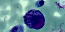 Cytomegalovirus - příznaky, příčiny a léčba