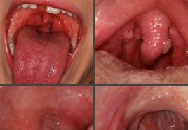 Papilomatoza grkljana: uzroci, simptomi, načela dijagnoze i liječenja papiloma na krajniku