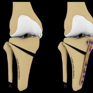 Osteotomijos tipai: skara, ševronas, Salter, Akin ir kt