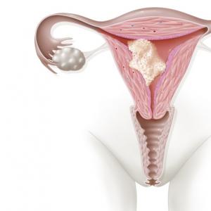 짧은 자궁경부 치료 자궁경부가 커지나요?