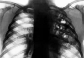 Dekodiranje rendgenske snimke pluća online: osnove, algoritam za čitanje rendgenske snimke