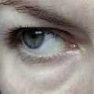 Göz altı şişmesi: fotoğraf, nedenleri ve tedavisi Yatmadan önce sabahları şişmiş gözler için.