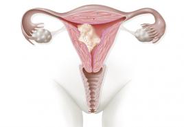 Liječenje kratkog grlića maternice Povećava li se grlić materice