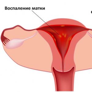 Uzroci oštrog bola u donjem dijelu trbuha kod žena