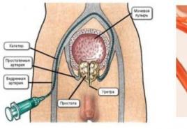Vasküler embolizasyon kullanılarak prostat adenomunun ameliyatsız tedavisi nerede ve nasıl yapılır?
