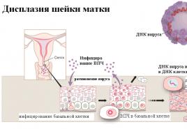 자궁 경부 이형성증 : 단계, 원인, 증상