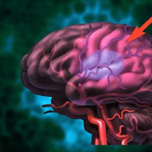 Příznaky a léčba mozkové ischemie