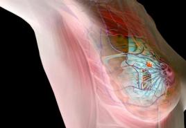 Fibróza prsu: příčiny a důsledky patologie, principy léčby Fibrózní provazce mléčné žlázy