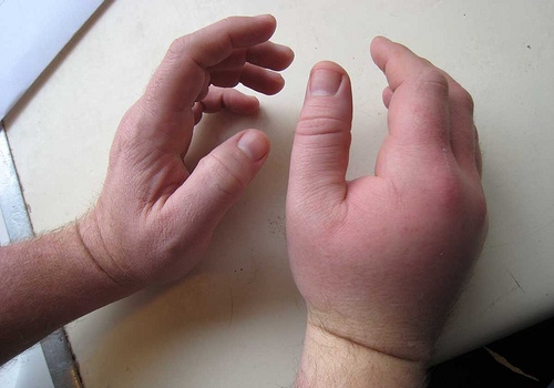 Ушиб руки у ребенка - признаки, симптомы и лечение в «СМ-Клиника» для детей и подростков