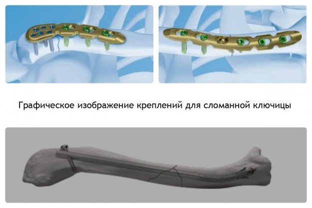 Пластина ключица реабилитация. Остеосинтез ключицы пластиной. Титановая пластина для ключицы. Пластина при переломе ключицы.