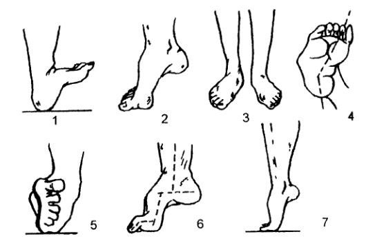 Синдром шарко. Невральная амиотрофия Шарко-Мари-Тутта. Эквинусная деформация стопы.