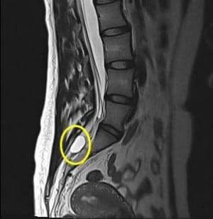 Киста крестца. Спинальная арахноидальная киста. Киста позвоночника фото.